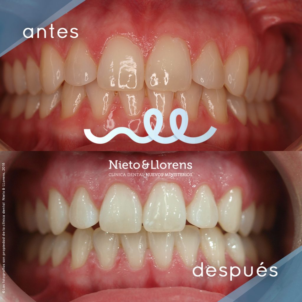 clinica dental nieto y llorens fotos antes y después caso 1