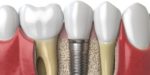 modleo 3d implante dental