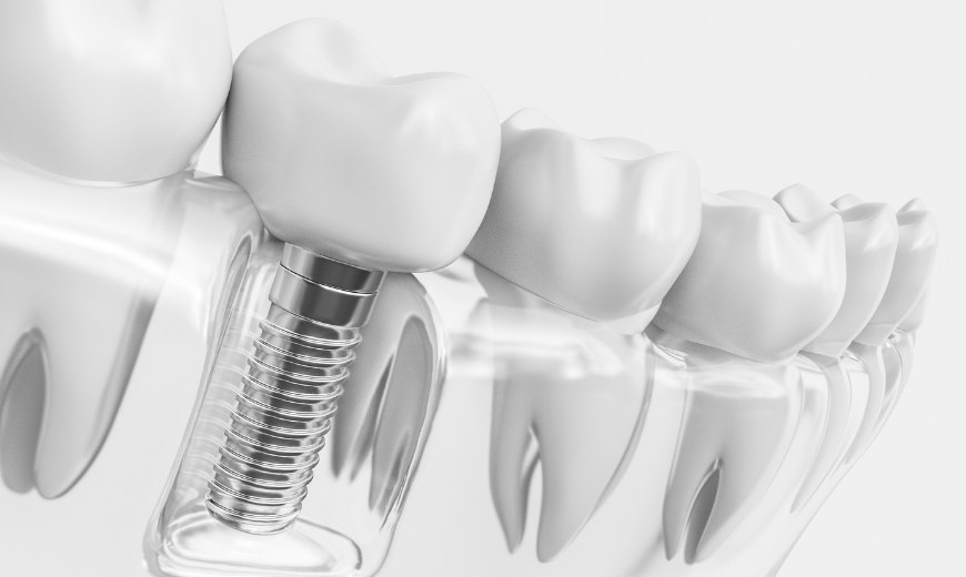 render 3d implante dental