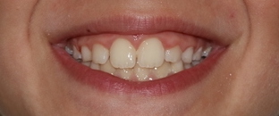 después ortodoncia infantil