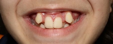 antes ortodoncia convencional
