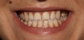 dientes paciente antes
