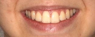 después ortodoncia convencional