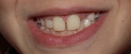 antes ortodoncia infantil