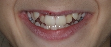 antes ortodoncia invisalign